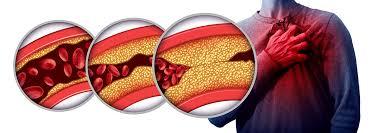 Myocardial Infarction: Causes, Symptoms, Diagnosis, Treatment & Best Cardiologists in Hyderabad